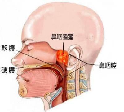 鼻咽癌：广东瘤的真相，可治愈的“中国特色”癌症
