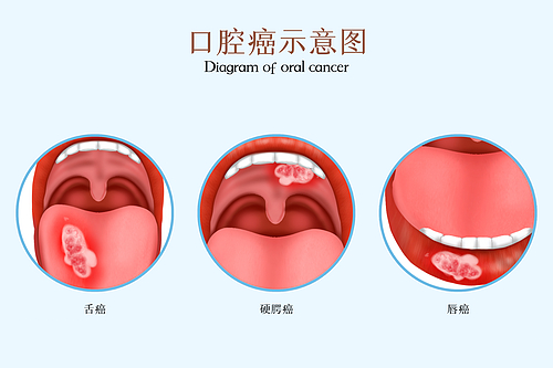 口腔癌.png